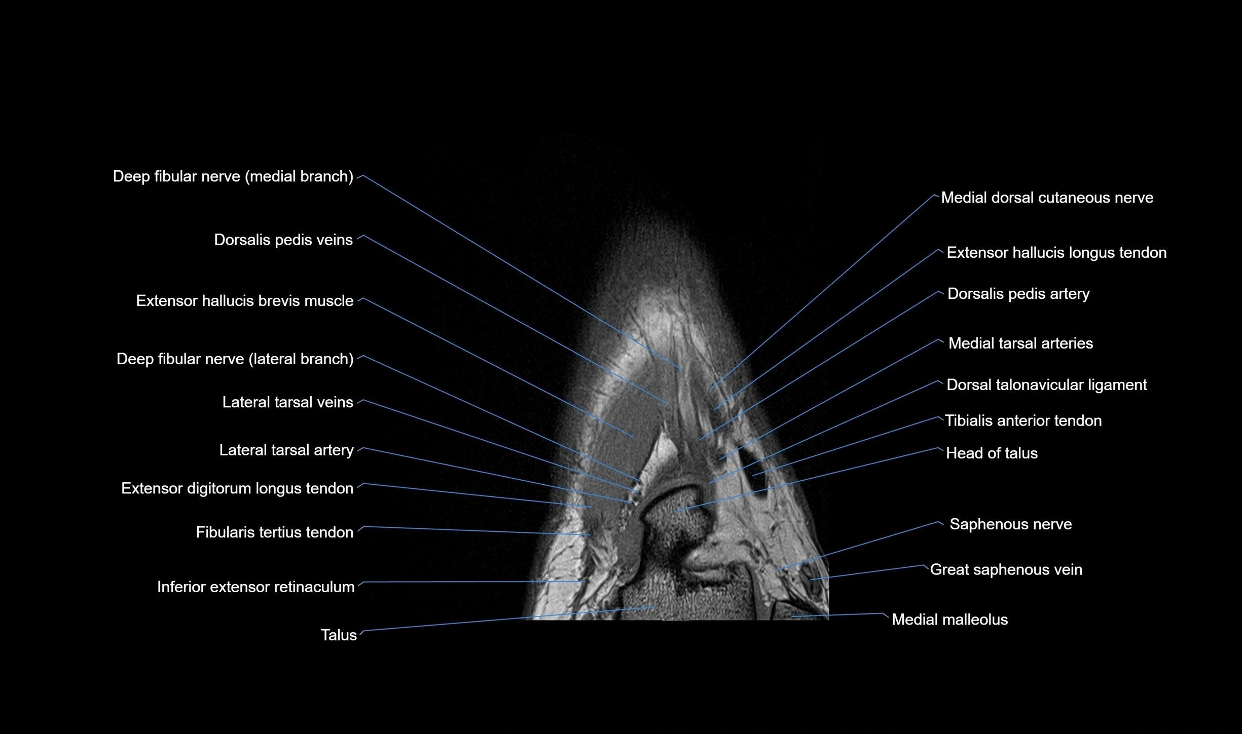 MRI mid foot coronal ligaments cross sectional anatomy 3T  radiology  image-img-00001-00010.webp